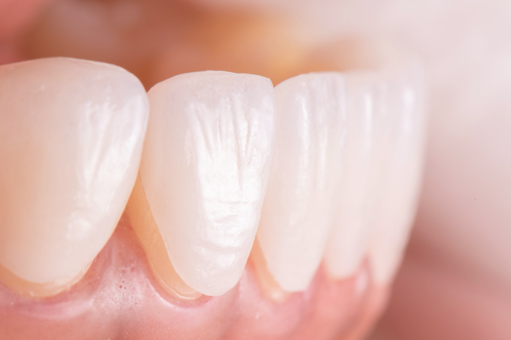 Veneers in Roanoke, VA - Mill Mountain Dentistry By Opulent Dental
