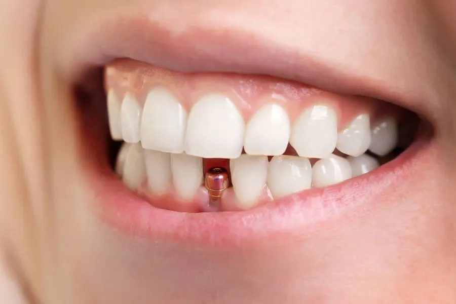 All-on-4 Dental Implants Near Salem, VA - Mill Mountain Dentistry By Opulent Dental