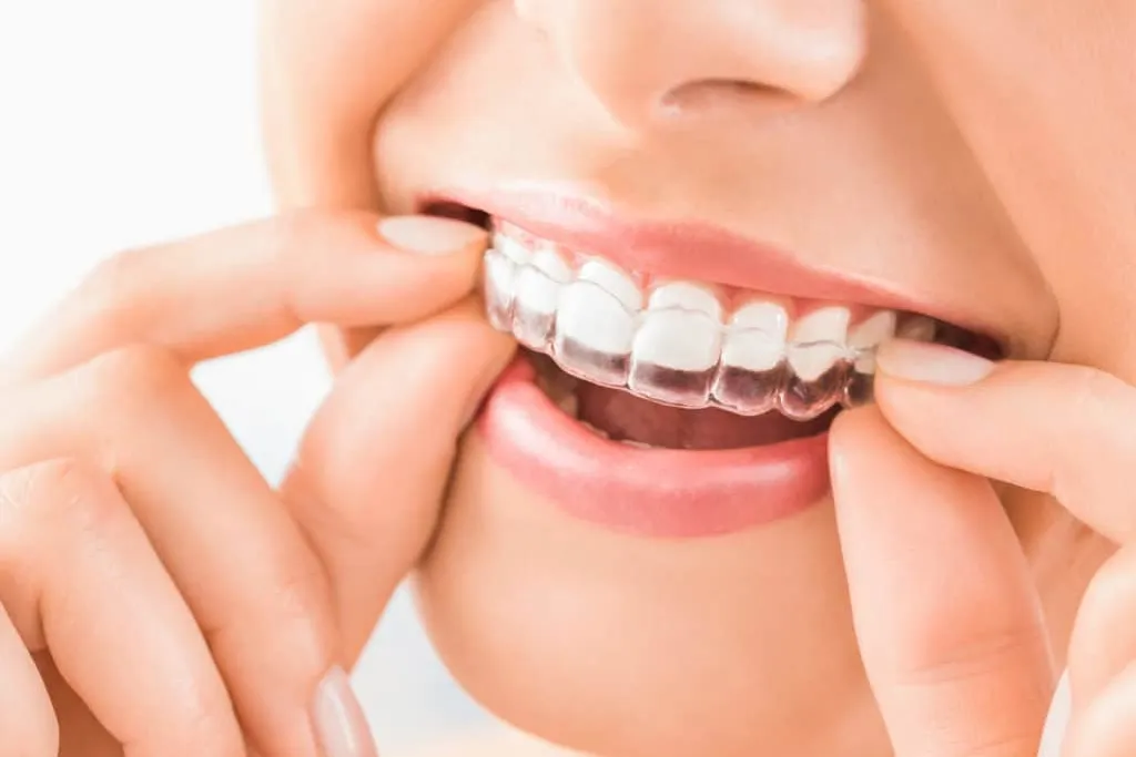 Clear Aligners Near Salem, VA - Mill Mountain Dentistry By Opulent Dental