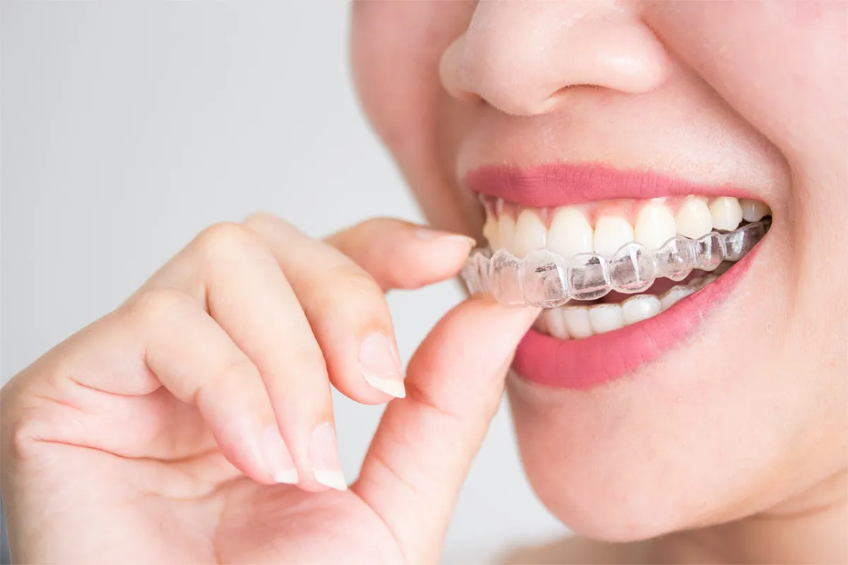 Clear Aligners Near Vinton, VA - Mill Mountain Dentistry By Opulent Dental