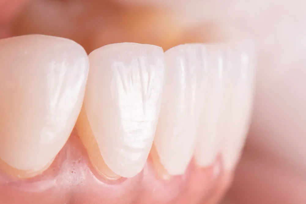 Clear Braces in Cave Spring, VA - Mill Mountain Dentistry By Opulent Dental