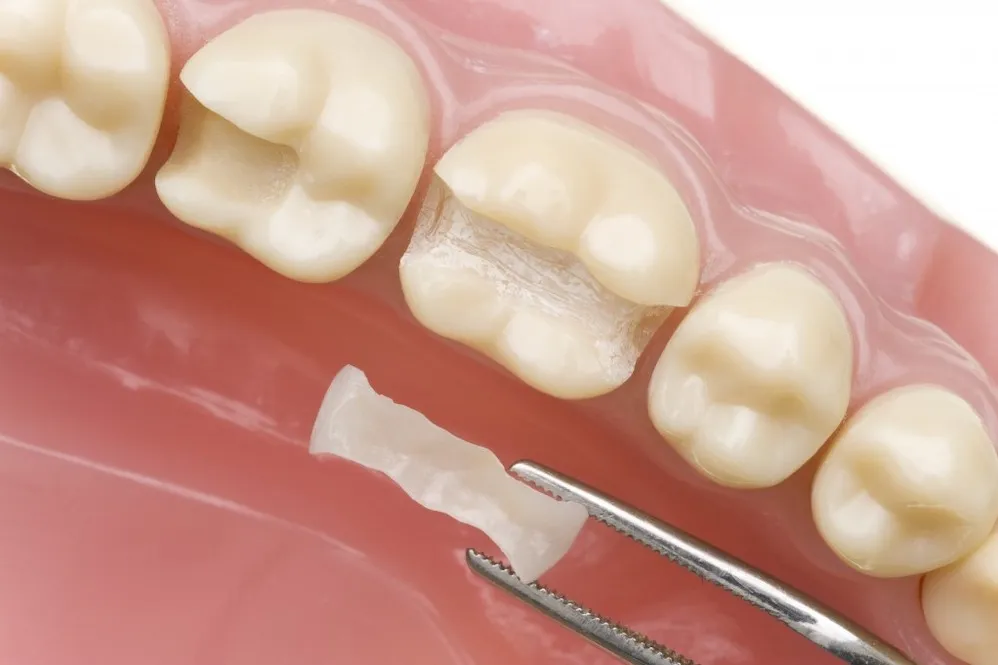 Fixed Implant Dentures in Roanoke, VA - Mill Mountain Dentistry By Opulent Dental