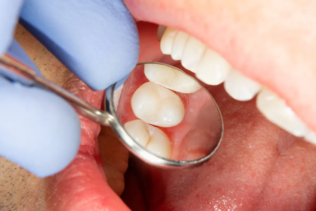 Full-Mouth Dental Implants Near Vinton, VA - Mill Mountain Dentistry By Opulent Dental